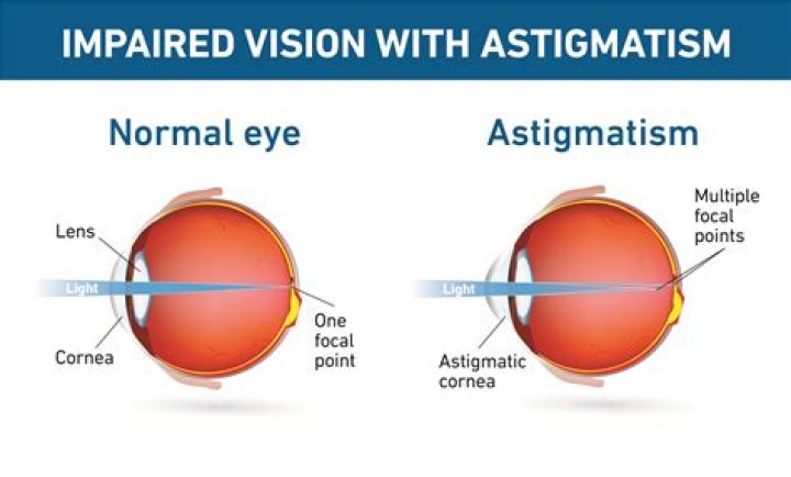 Unveiling The Secrets Of Astigmatism: Discoveries And Insights